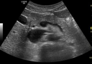 Songrafie des Pankreas