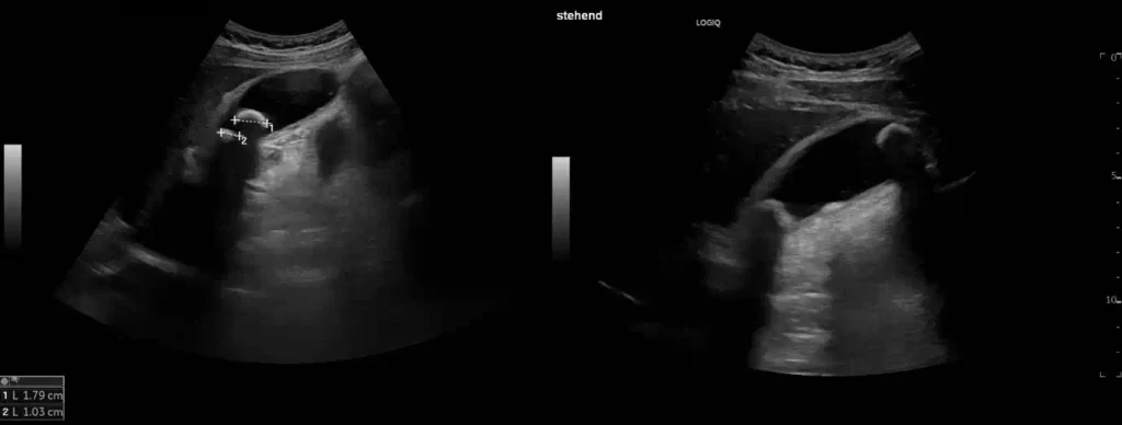 Lageverschieblichkeit zweier Gallenblasenkonkremente mit akuter Cholezystitis