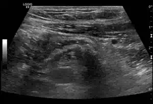 Pathologien der Appendix