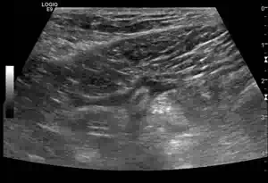 Pathologien der Appendix