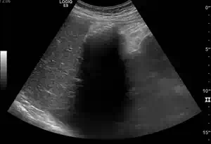 Pathologien der Gallenblase